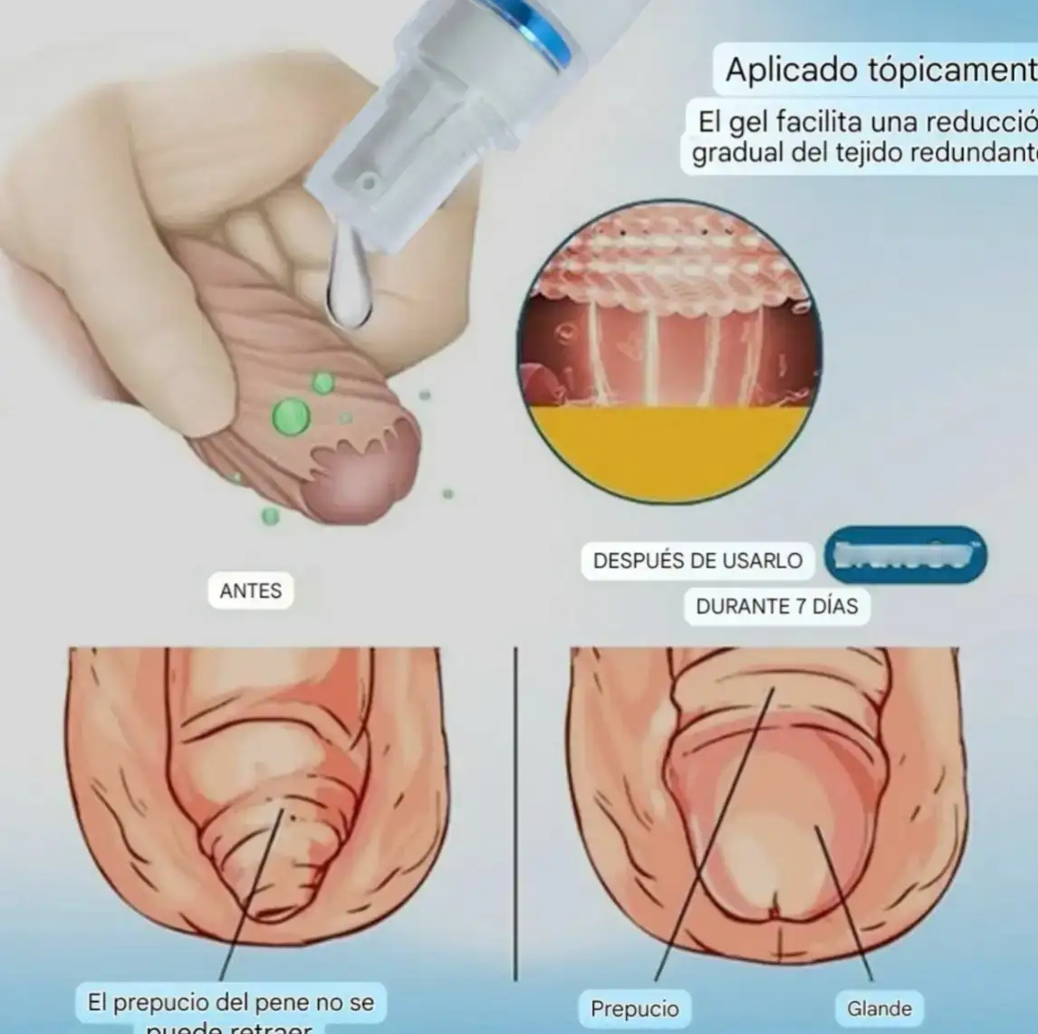 Gel Corrector de Prepucio 2