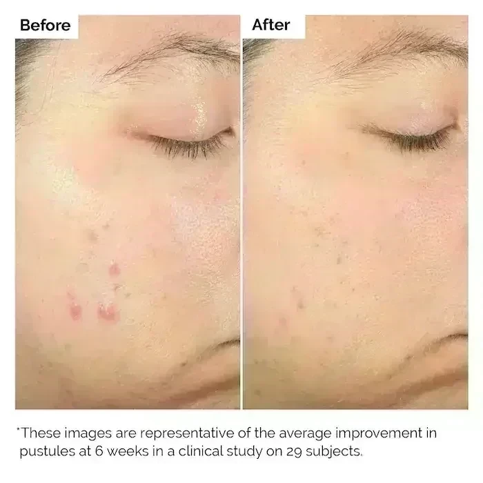 The Ordinary Salicylic Acid 2% Exfoliating Blemish Solution 2