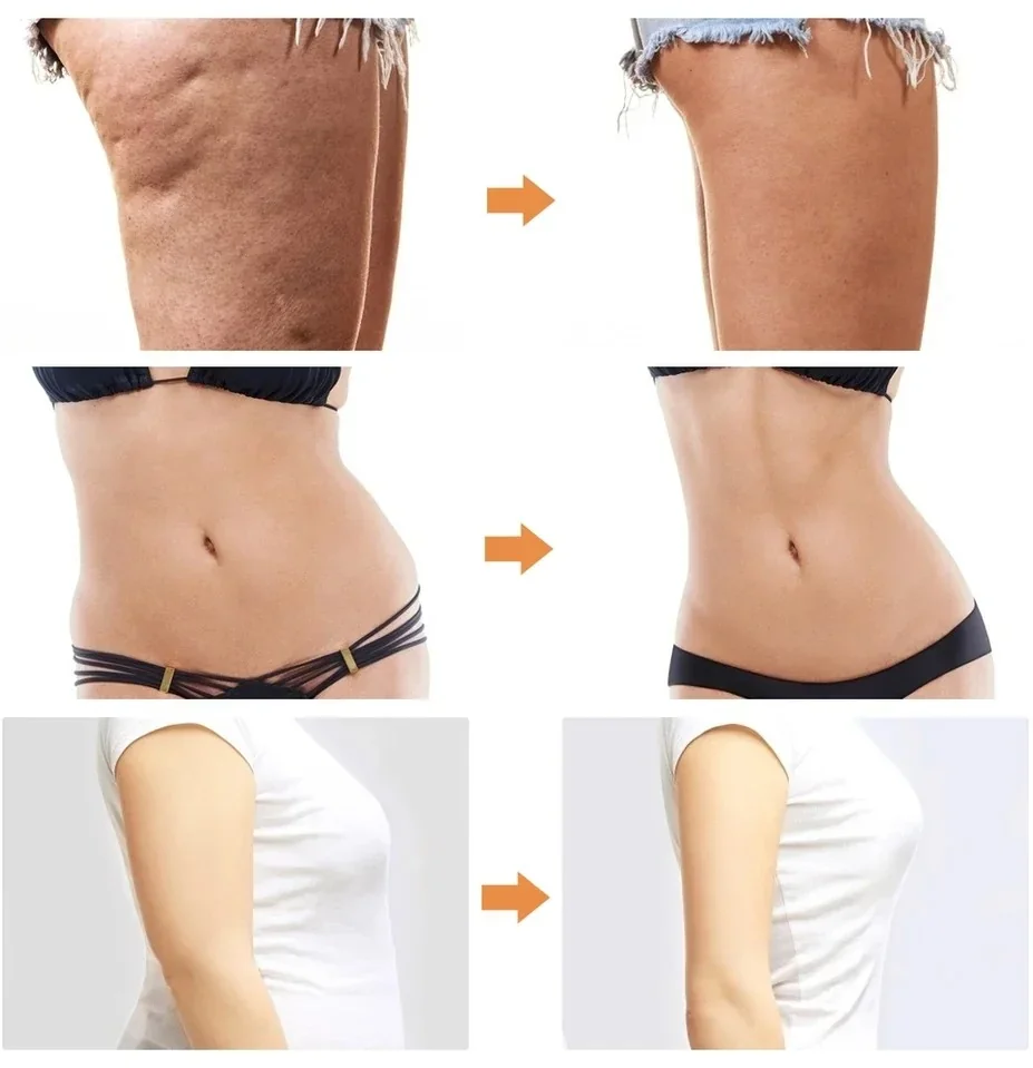 Máquina de liposucción VE Sport  3