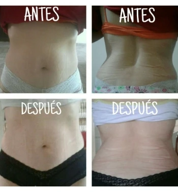 Faja De Yeso Lipoyesoterapia 2