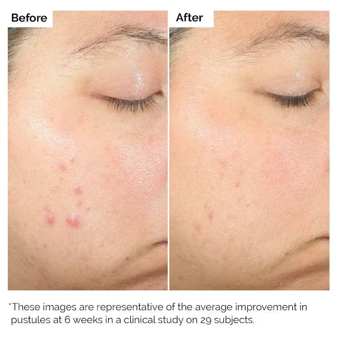 Serum Ácido Salicílico The Ordinary 30 ml 4