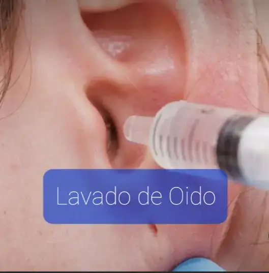 Lavado de Oido