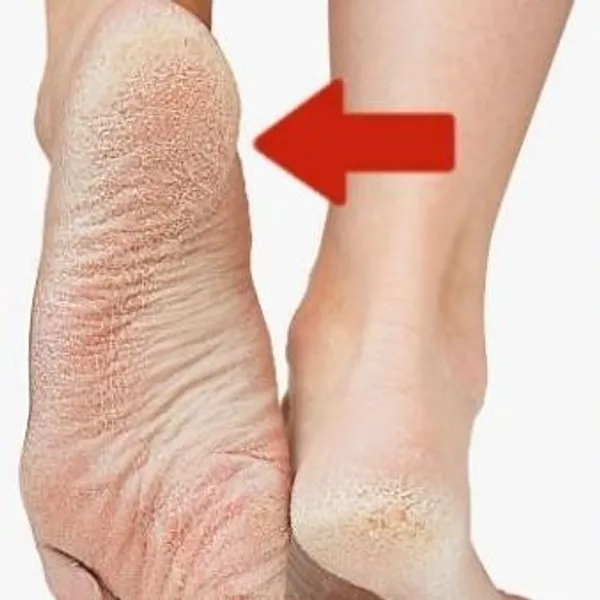 Exfoliante para piés extracto de miel 2