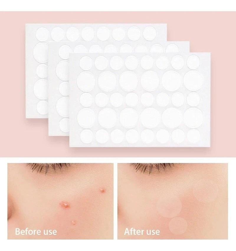 ✨ Acne Cover Patch –the original ✨    Dile adiós a los granitos molestos 2