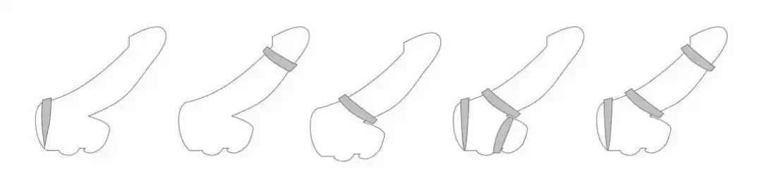 3 Anillos Retardantes 4