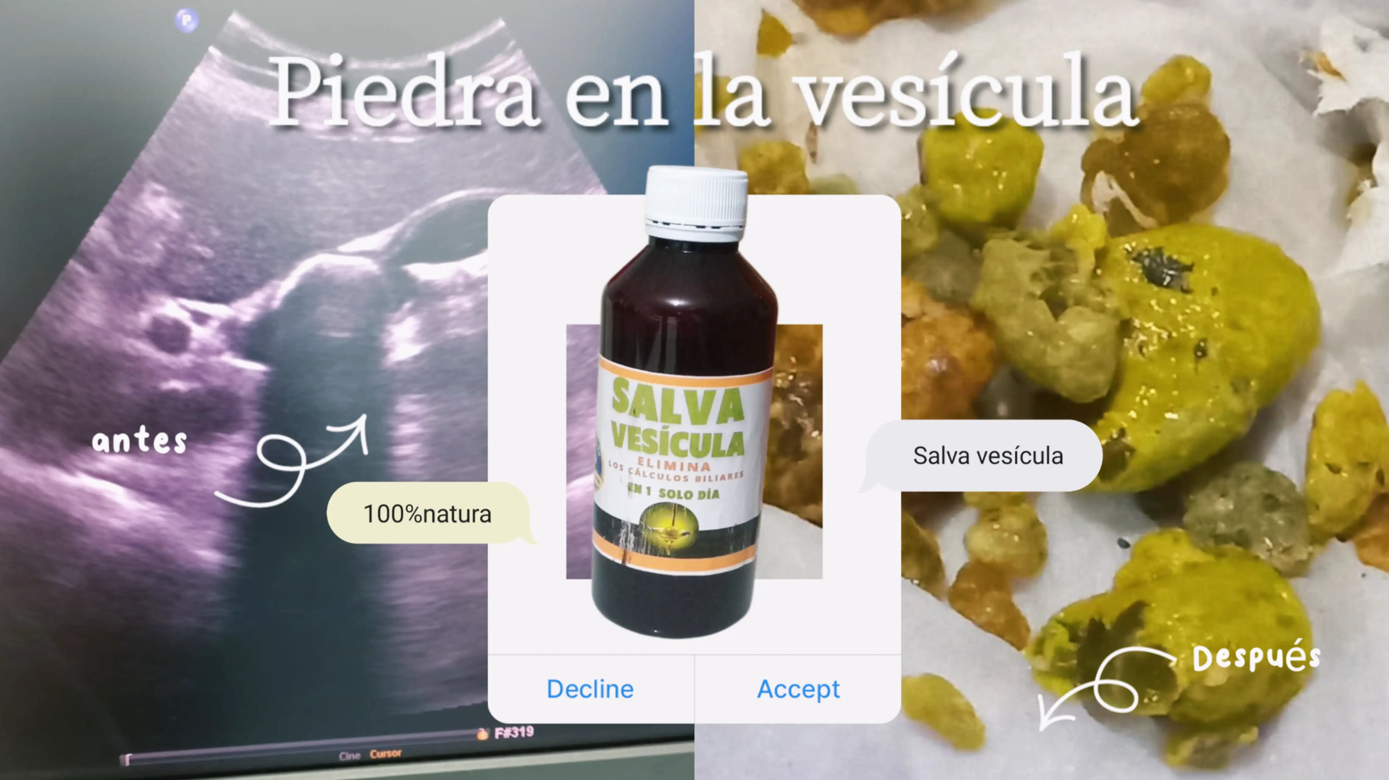 Piedra en la vesicula  2