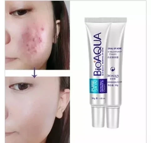 Crema para el acné bioaqua 🤗🌺💕 3