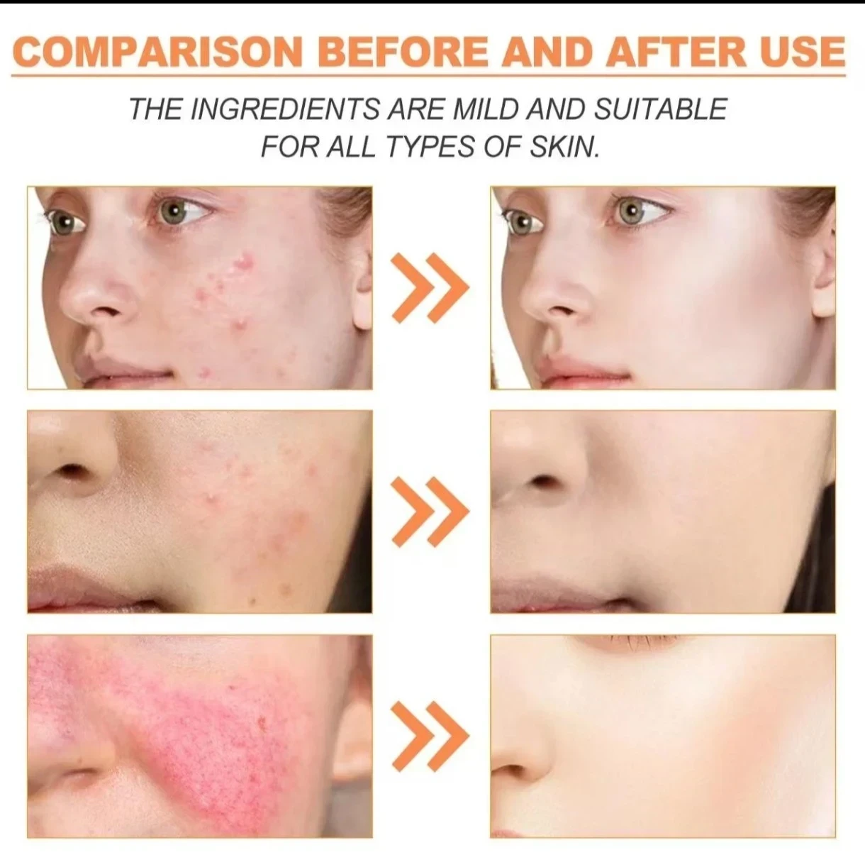 💚 SADOER Anti-Acne Repair Cream (con Ácido Azelaico + Tea Tree) 3