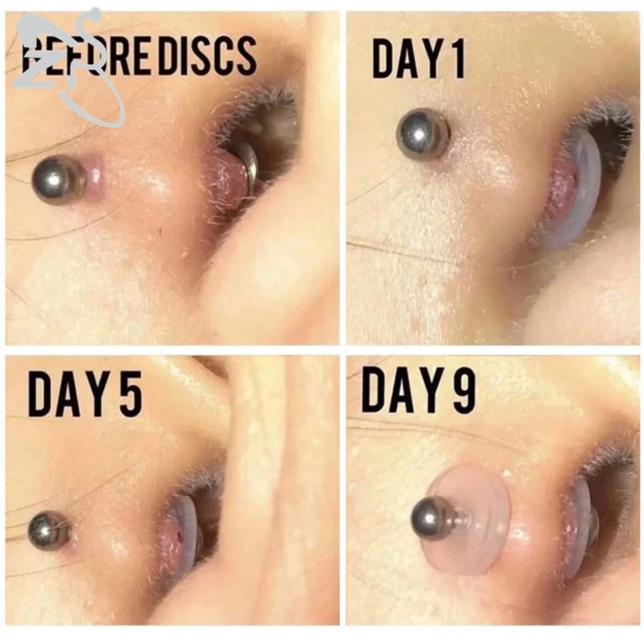 Discos Silicona Biocompatible Reduce Queloides 8
