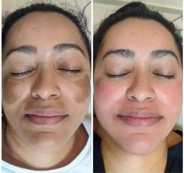🌻ÁCIDO GLICÓLICO ROUTINE🌻 2