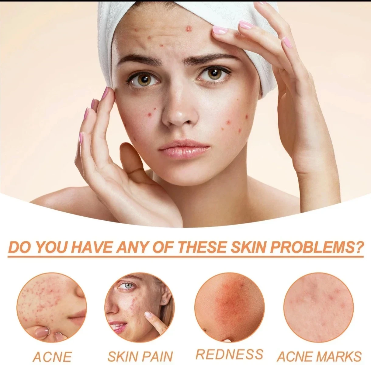 💚 SADOER Anti-Acne Repair Cream (con Ácido Azelaico + Tea Tree) 2