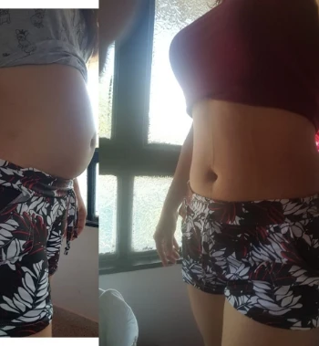 Faja De Yeso Lipoyesoterapia 3