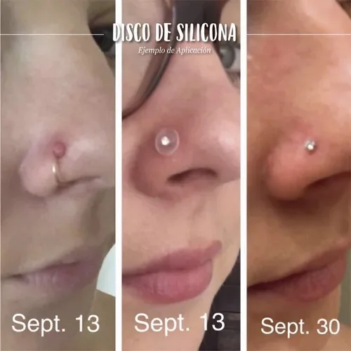 Discos Silicona Biocompatible Reduce Queloides