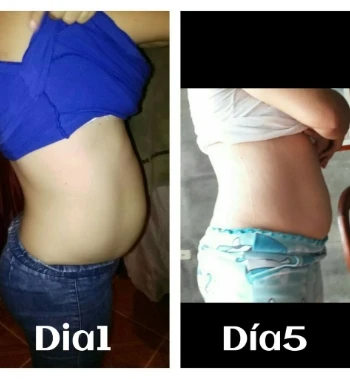 Faja De Yeso Lipoyesoterapia 4