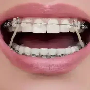 Elastico intra oral 5/16 médio  2